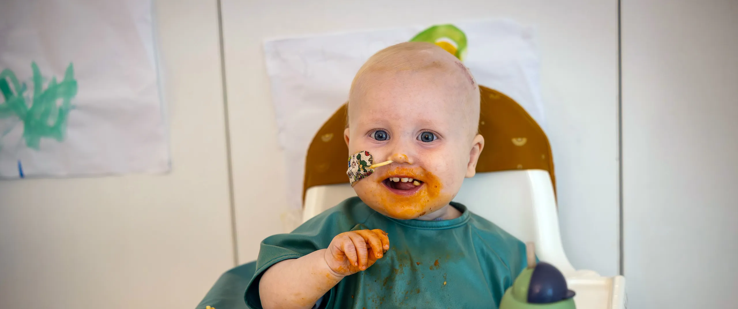 A baby with food on their face and a nose tube.